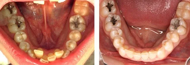 lower arch invisalign before and after