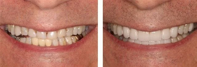 Before and after smile Elizabeth Russ Dental