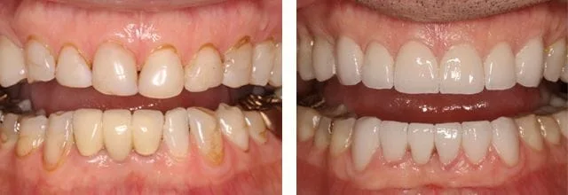 Elizabeth Russ Dental Needham teeth picture before and after