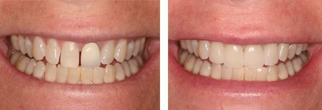 cosmetic dental before and after needham