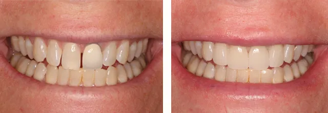cosmetic dental before and after needham