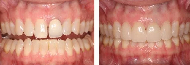 Cosmetic Needham dentist befor and after picture
