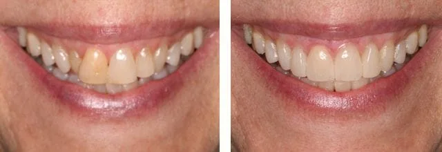 Dentist in Needham before and after dental work