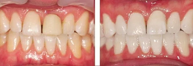 Before and after picture with front implant crown