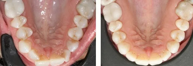 Needham Dentist before and after photos of lower arch after ortho