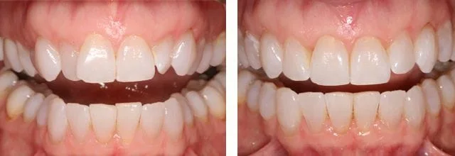 before and after pictures of a bite after ortho