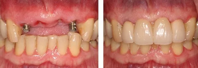 before and after smile missing front teeth