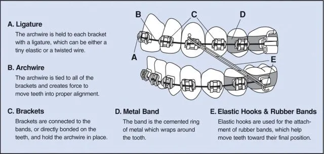 Braces Diagram  Wright Orthodontics Atlanta, Marietta, GA