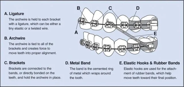 Medium Braces Components