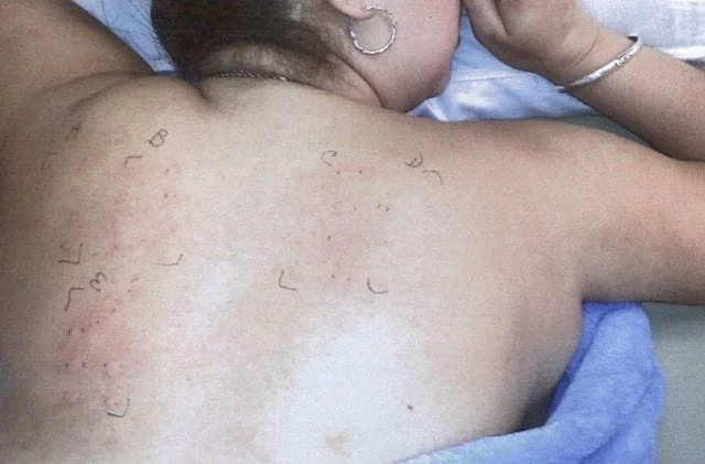 Woman's back with Allergic Reaction