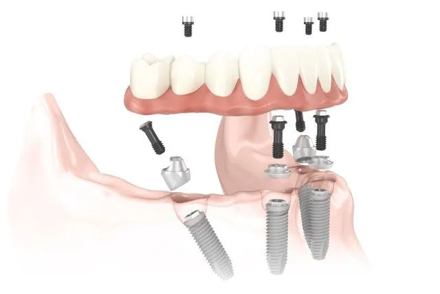 All on 4 Dental Implants Brandon FL