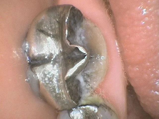 Broken Tooth Lethbridge, AB