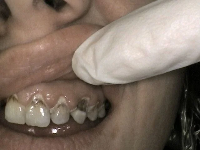 Tooth Decay Lethbridge, AB
