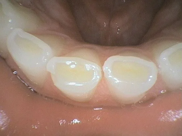 Tooth Grinding Lethbridge, AB
