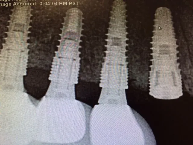 implant body and finished implant crowns