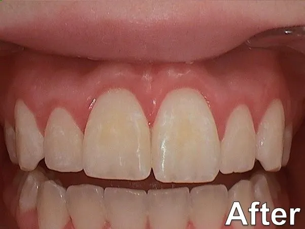 Gummy Smile 2019 b After