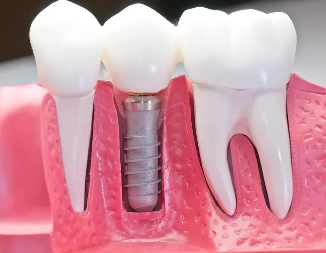 dental implants in Kitchener, ON