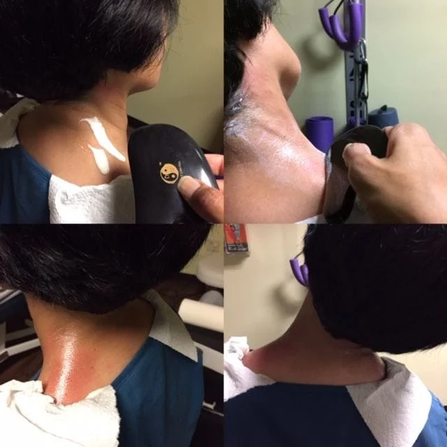 Gua Sha for Neck Pain and Stiffness