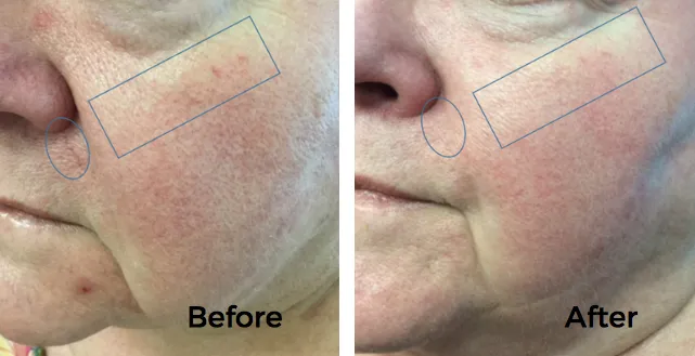 Laser Treatments Before and After