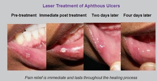 Laser Treatment of Apthous Ulcer