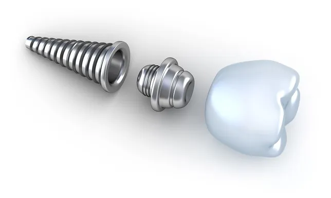 Dental Implants Brooklyn NY | Dentist