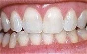 Teeth Whitening