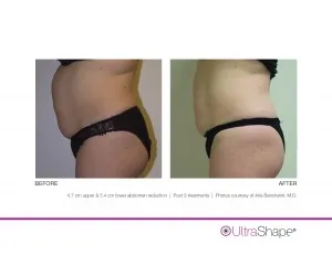 UltraShape