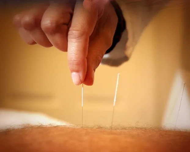 Acupuncture