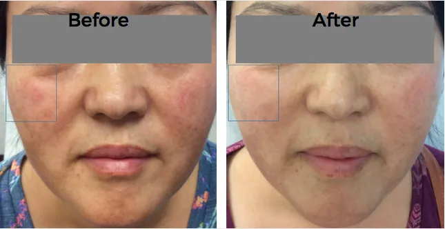 Laser Treatments Before and After