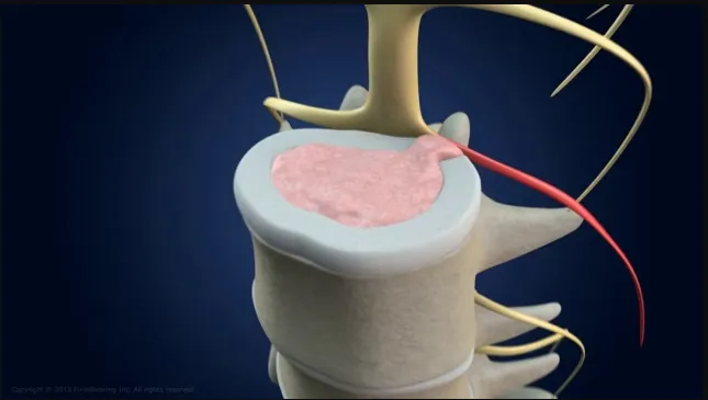 Spinal Decompression Explianed Video