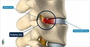 disc herniation