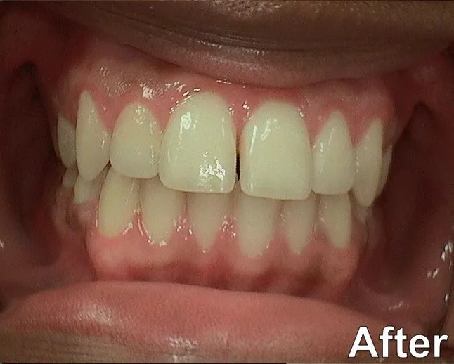 Gummy Smile 2015 After