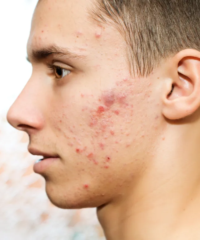 acne