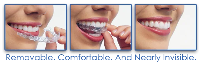 Cost of Invisalign Chicago Streeterville