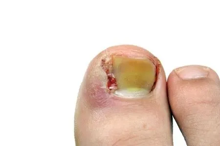 Ingrown Toenails