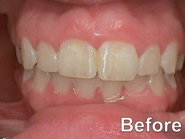 Gummy Smile 2019 b Before