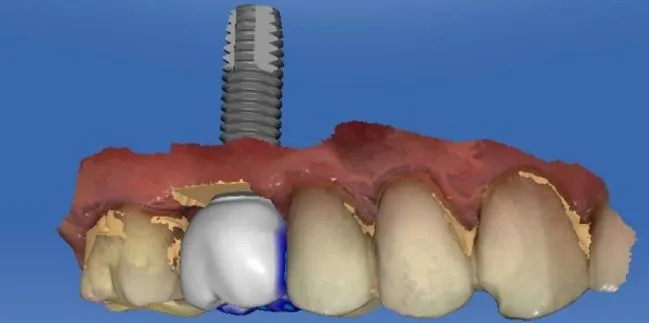 Dental Implants Creve Coeur, MO