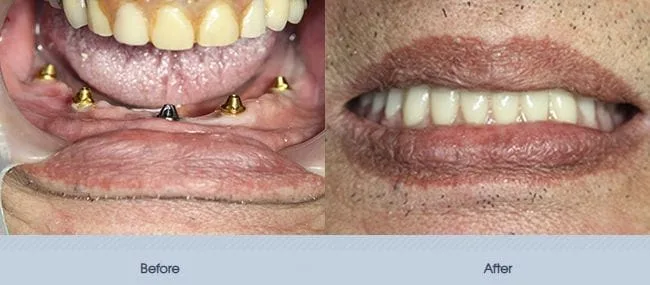 Full Mouth Implant Restoration