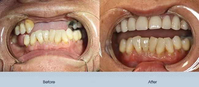 Full Mouth Implants and Fixed Dentures