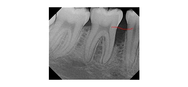 Bone graft- red line depicts where bone level should be