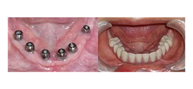 Implants before and after