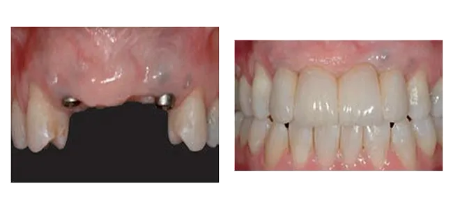 Implants in position and final restoration