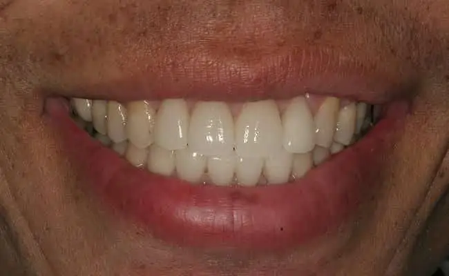 After Treatment, Dentist Upland CA