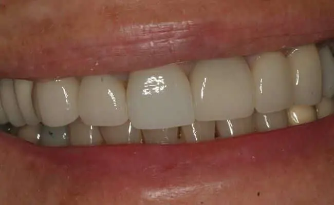 After Treatment, Dentist Upland CA