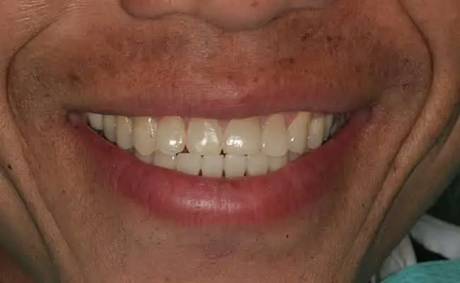 Before Treatment, Dentist Upland CA