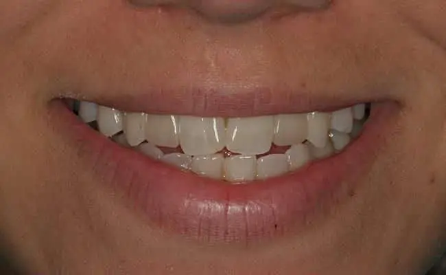 Before Treatment, Dentist Upland CA