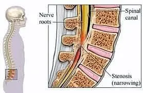 stenosis_narrowing_1.jpg