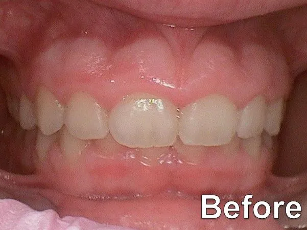 Gummy Smile 2019 before