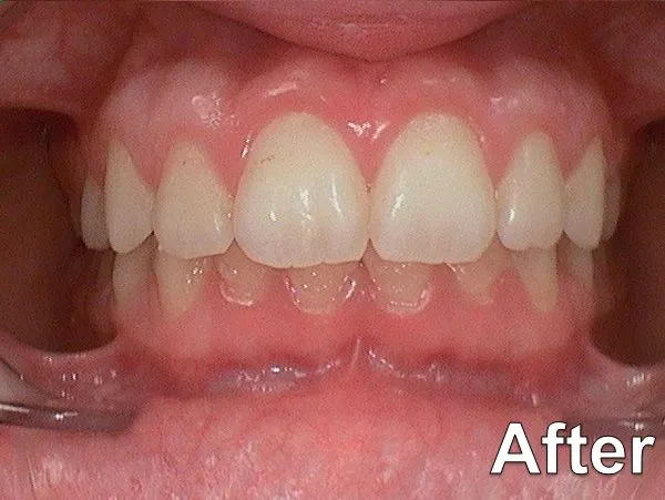 Gummy Smile 2019 after