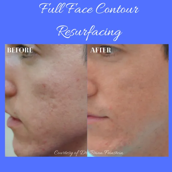 Resurfacing Acne Scars
